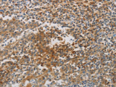 The image on the left is immunohistochemistry of paraffin-embedded Human tonsil tissue using the antibody Antibody) at dilution 1/80, on the right is treated with synthetic peptide. (Original magnification: ×200)Rabbit anti-Human CKMT1A Polyclonal Antibody