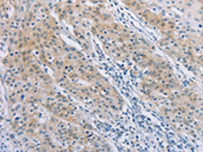 The image on the left is immunohistochemistry of paraffin-embedded Human gastric cancer tissue using AGAP2 Antibody(AGAP2 Antibody) at dilution 1/30, on the right is treated with synthetic peptide. (Original magnification: ×200)