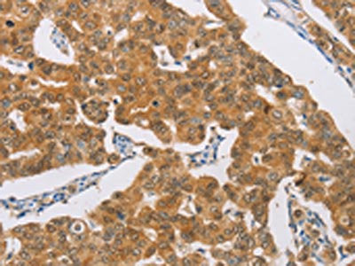 The image on the left is immunohistochemistry of paraffin-embedded Human breast cancer tissue using the antibody Antibody) at dilution 1/30, on the right is treated with synthetic peptide. (Original magnification: ×200)