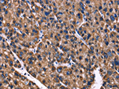 The image on the left is immunohistochemistry of paraffin-embedded Human liver cancer tissue using the antibody Antibody) at dilution 1/40, on the right is treated with fusion protein. (Original magnification: ×200)Rabbit anti-Human PHB Polyclonal Antibody