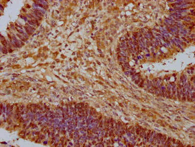 IHC image of YWHAZ Antibody diluted at 1:1000 and staining in paraffin-embedded human ovarian cancer performed on a Leica BondTM system. After dewaxing and hydration, antigen retrieval was mediated by high pressure in a citrate buffer (pH 6.0). Section was blocked with 10% normal goat serum 30min at RT. Then primary antibody (1% BSA) was incubated at 4°C overnight. The primary is detected by a biotinylated secondary antibody and visualized using an HRP conjugated SP system.Rabbit anti-Human YWHAZ Polyclonal Antibody