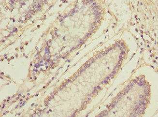 Immunohistochemistry of paraffin-embedded human colon cancer using MLF1 Antibody at dilution of 1:100Rabbit anti-Human MLF1 Polyclonal Antibody