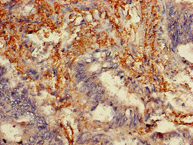 Immunohistochemistry of paraffin-embedded human colon cancer using the antibody at dilution of 1:100Rabbit anti-Human MLPH Polyclonal Antibody