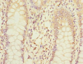 Immunohistochemistry of paraffin-embedded human colon cancer using MPI Antibody at dilution of 1:100Rabbit anti-Human MPI Polyclonal Antibody