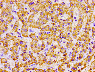 Immunohistochemistry of paraffin-embedded human liver cancer using MPST Antibody at dilution of 1:100