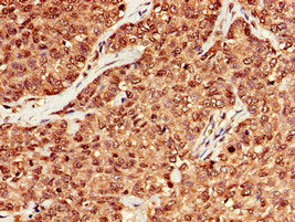 Immunohistochemistry of paraffin-embedded human ovarian cancer using the antibody at dilution of 1:100