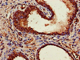Immunohistochemistry of paraffin-embedded human prostate cancer using MRE11A Antibody at dilution of 1:100