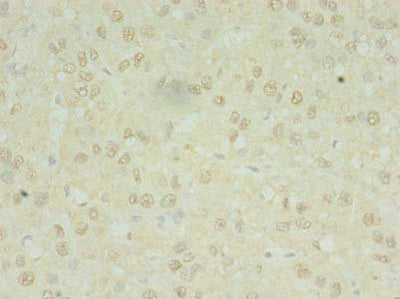 Immunohistochemistry of paraffin-embedded human liver cancer using MRPL3 Antibody at dilution of 1:100Rabbit anti-Human MRPL3 Polyclonal Antibody