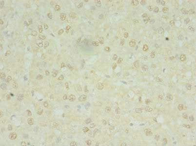 Immunohistochemistry of paraffin-embedded human liver cancer using MRPL3 Antibody at dilution of 1:100Rabbit anti-Human MRPL3 Polyclonal Antibody
