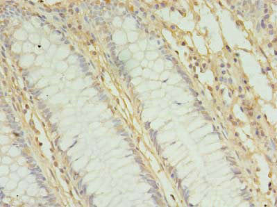 Immunohistochemistry of paraffin-embedded human colon cancer using MRPL3 Antibody at dilution of 1:100Rabbit anti-Human MRPL3 Polyclonal Antibody
