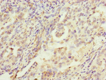 Immunohistochemistry of paraffin-embedded human lung cancer using MRPS22 Antibody at dilution of 1:100Rabbit anti-Human MRPS22 Polyclonal Antibody