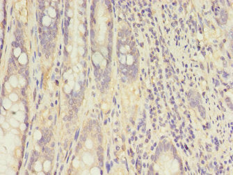 Immunohistochemistry of paraffin-embedded human colon cancer using CKB Antibody at dilution of 1:100Rabbit anti-Human CKB Polyclonal Antibody
