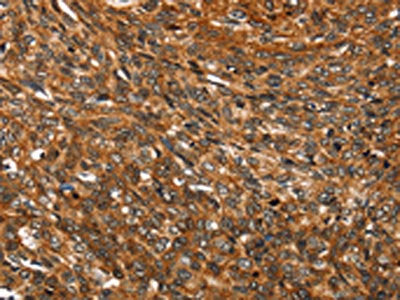 The image on the left is immunohistochemistry of paraffin-embedded Human esophagus cancer tissue using SMARCB1 Antibody(SMARCB1 Antibody) at dilution 1/35, on the right is treated with fusion protein. (Original magnification: ×200)Rabbit anti-Human SMARCB1 Polyclonal Antibody