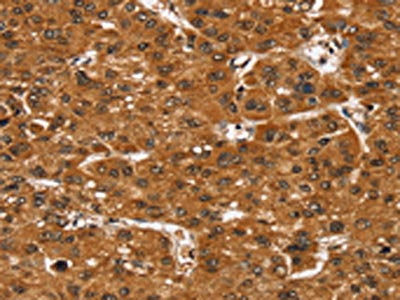 The image on the left is immunohistochemistry of paraffin-embedded Human liver cancer tissue using the antibody Antibody) at dilution 1/35, on the right is treated with fusion protein. (Original magnification: ×200)Rabbit anti-Human SMARCB1 Polyclonal Antibody