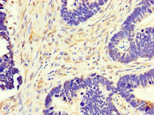 Immunohistochemistry of paraffin-embedded human ovarian cancer using the antibody at dilution of 1:100Rabbit anti-Human MT-CO1 Polyclonal Antibody