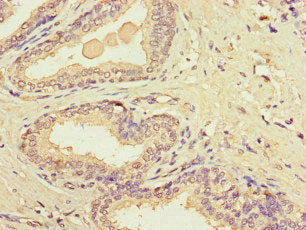 Immunohistochemistry of paraffin-embedded human prostate cancer using MT-CO1 Antibody at dilution of 1:100Rabbit anti-Human MT-CO1 Polyclonal Antibody