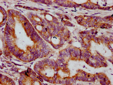 IHC image of MT-CO2 Antibody diluted at 1:400 and staining in paraffin-embedded human colon cancer performed on a Leica BondTM system. After dewaxing and hydration, antigen retrieval was mediated by high pressure in a citrate buffer (pH 6.0). Section was blocked with 10% normal goat serum 30min at RT. Then primary antibody (1% BSA) was incubated at 4°C overnight. The primary is detected by a biotinylated secondary antibody and visualized using an HRP conjugated SP system.Rabbit anti-Human MT-CO2 Polyclonal Antibody