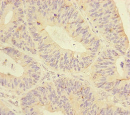 Immunohistochemistry of paraffin-embedded human colon cancer using MTHFD2 Antibody at dilution of 1:100Rabbit anti-Human MTHFD2 Polyclonal Antibody