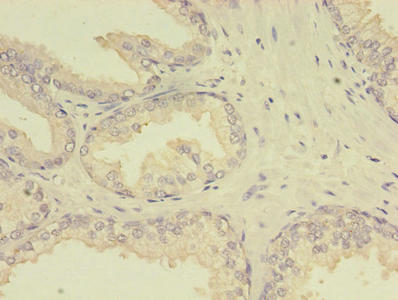 Immunohistochemistry of paraffin-embedded human prostate cancer using MTHFR Antibody at dilution of 1:100Rabbit anti-Human MTHFR Polyclonal Antibody