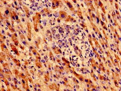 Immunohistochemistry of paraffin-embedded human liver cancer using MTRF1 Antibody at dilution of 1:100Rabbit anti-Human MTRF1 Polyclonal Antibody