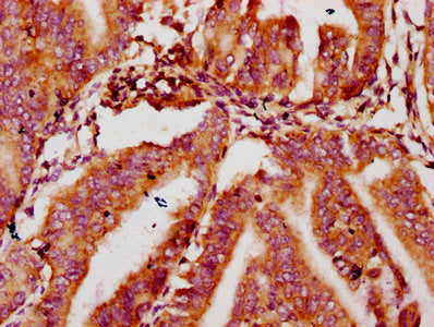 IHC image of MTSS1 Antibody diluted at 1:400 and staining in paraffin-embedded human endometrial cancer performed on a Leica BondTM system. After dewaxing and hydration, antigen retrieval was mediated by high pressure in a citrate buffer (pH 6.0). Section was blocked with 10% normal goat serum 30min at RT. Then primary antibody (1% BSA) was incubated at 4°C overnight. The primary is detected by a biotinylated secondary antibody and visualized using an HRP conjugated SP system.Rabbit anti-Human MTSS1 Polyclonal Antibody