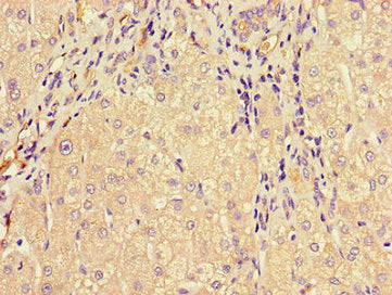 Immunohistochemistry of paraffin-embedded human liver cancer using MTTP Antibody at dilution of 1:100Rabbit anti-Human MTTP Polyclonal Antibody
