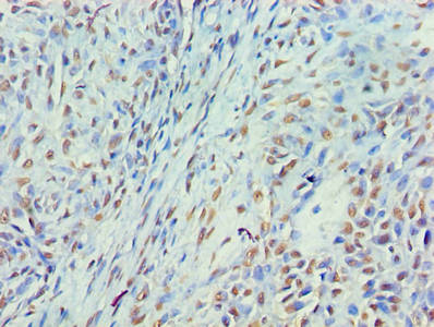 Immunohistochemistry of paraffin-embedded human breast cancer using the antibody at dilution of 1:100Rabbit anti-Human MYEF2 Polyclonal Antibody