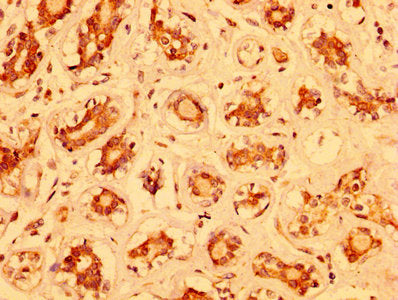 IHC image of MZF1 Antibody diluted at 1:400 and staining in paraffin-embedded human breast cancer performed on a Leica BondTM system. After dewaxing and hydration, antigen retrieval was mediated by high pressure in a citrate buffer (pH 6.0). Section was blocked with 10% normal goat serum 30min at RT. Then primary antibody (1% BSA) was incubated at 4°C overnight. The primary is detected by a biotinylated secondary antibody and visualized using an HRP conjugated SP system.Rabbit anti-Human MZF1 Polyclonal Antibody