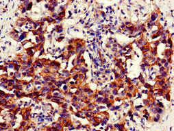 Immunohistochemistry of paraffin-embedded human bladder cancer using NAMPT Antibody at dilution of 1:100Rabbit anti-Human NAMPT Polyclonal Antibody