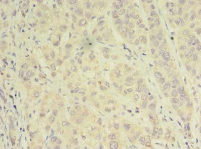 Immunohistochemistry of paraffin-embedded human liver cancer using NAPA Antibody at dilution of 1:100Rabbit anti-Human NAPA Polyclonal Antibody