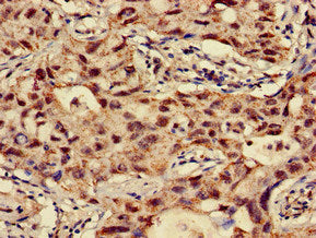 Immunohistochemistry of paraffin-embedded human lung cancer using the antibody at dilution of 1:100Rabbit anti-Human NAT1 Polyclonal Antibody