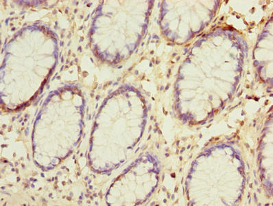 Immunohistochemistry of paraffin-embedded human colon cancer using NAT2 Antibody at dilution of 1:100Rabbit anti-Human NAT2 Polyclonal Antibody