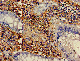 Immunohistochemistry of paraffin-embedded human colon cancer using NCF1 Antibody at dilution of 1:100Rabbit anti-Human NCF1 Polyclonal Antibody