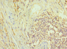 Immunohistochemistry of paraffin-embedded human colon cancer using NCK1 Antibody at dilution of 1:100Rabbit anti-Human NCK1 Polyclonal Antibody
