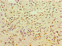 Immunohistochemistry of paraffin-embedded human breast cancer using NCK2 Antibody at dilution of 1:100Rabbit anti-Human NCK2 Polyclonal Antibody