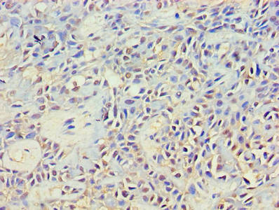 Immunohistochemistry of paraffin-embedded human breast cancer using NCK2 Antibody at dilution of 1:100Rabbit anti-Human NCK2 Polyclonal Antibody