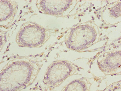 Immunohistochemistry of paraffin-embedded human colon cancer using RPA2 Antibody at dilution of 1:100Rabbit anti-Human RPA2 Polyclonal Antibody
