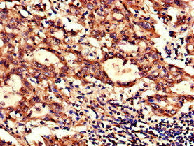 Immunohistochemistry of paraffin-embedded human lung cancer using NDUFB6 Antibody at dilution of 1:100Rabbit anti-Human NDUFB6 Polyclonal Antibody