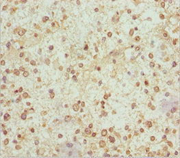 Immunohistochemistry of paraffin-embedded human glioma using NDUFS1 Antibody at dilution of 1:100Rabbit anti-Human NDUFS1 Polyclonal Antibody