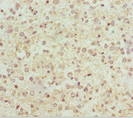 Immunohistochemistry of paraffin-embedded human glioma using NDUFS1 Antibody at dilution of 1:100Rabbit anti-Human NDUFS1 Polyclonal Antibody