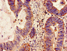 Immunohistochemistry of paraffin-embedded human colon cancer using NDUFS4 Antibody at dilution of 1:100Rabbit anti-Human NDUFS4 Polyclonal Antibody