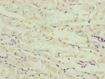 Immunohistochemistry of paraffin-embedded human gastric cancer using NDUFS6 Antibody at dilution of 1:100Rabbit anti-Human NDUFS6 Polyclonal Antibody