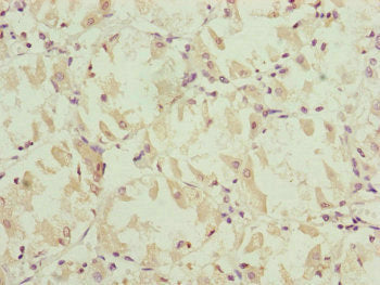 Immunohistochemistry of paraffin-embedded human gastric cancer using NDUFS6 Antibody at dilution of 1:100Rabbit anti-Human NDUFS6 Polyclonal Antibody