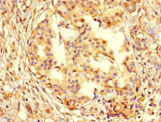 Immunohistochemistry of paraffin-embedded human pancreatic cancer using the antibody at dilution of 1:100Rabbit anti-Human PCNA Polyclonal Antibody