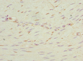 Immunohistochemistry of paraffin-embedded human colon cancer using NEK3 Antibody at dilution of 1:100Rabbit anti-Human NEK3 Polyclonal Antibody