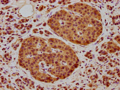 IHC image of the antibody diluted at 1:400 and staining in paraffin-embedded human pancreatic cancer performed on a Leica BondTM system. After dewaxing and hydration, antigen retrieval was mediated by high pressure in a citrate buffer (pH 6.0). Section was blocked with 10% normal goat serum 30min at RT. Then primary antibody (1% BSA) was incubated at 4°C overnight. The primary is detected by a biotinylated secondary antibody and visualized using an HRP conjugated SP system.Rabbit anti-Human NEURL1B Polyclonal Antibody