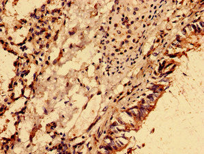 Immunohistochemistry analysis of human lung cancer using NME6 Antibody at dilution of 1:100Rabbit anti-Human NME6 Polyclonal Antibody
