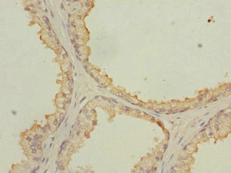 Immunohistochemistry of paraffin-embedded human prostate cancer using NMT2 Antibody at dilution of 1:100Rabbit anti-Human NMT2 Polyclonal Antibody