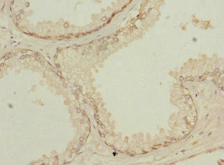 Immunohistochemistry of paraffin-embedded human prostate cancer using NMT2 Antibody at dilution of 1:100Rabbit anti-Human NMT2 Polyclonal Antibody