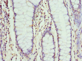 Immunohistochemistry of paraffin-embedded human colon cancer using NMU Antibody at dilution of 1:100Rabbit anti-Human NMU Polyclonal Antibody